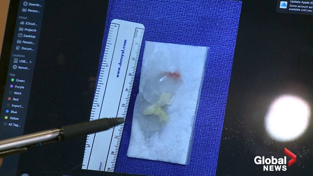 Click to play video: 'Tapeworm removed from man’s brain after months of headaches'