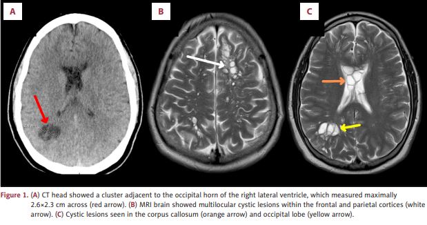 A neurocysticercosis egy olyan állapot, amelyet a Taenia solium okoz, amikor a ciszták beragadnak az idegrendszerbe [